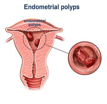 biopsy of polyp on uterus