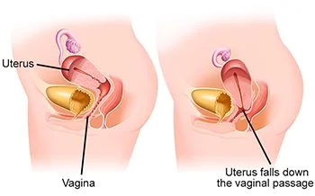 Pelvic Organ Prolapse Physical Therapy Treatment in New York City