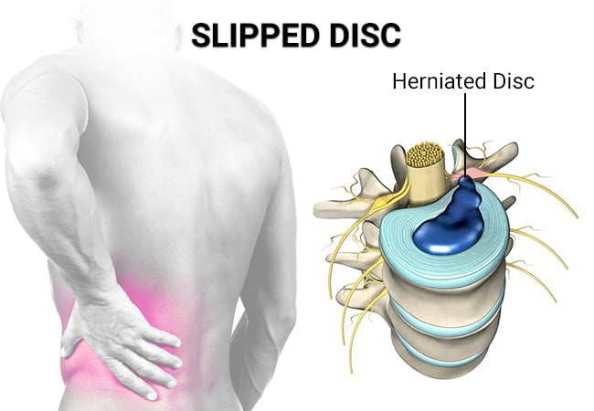 What Is A Slipped Disc? Here Are Its Signs, Causes Treatment And