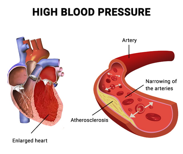https://www.centurymedicaldental.com/wp-content/uploads/2021/12/Anatomy-of-High-Blood-Pressure.jpg