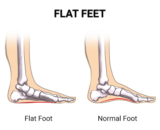 What Are the Best Insoles for Flat Feet? - Century Medical & Dental Center