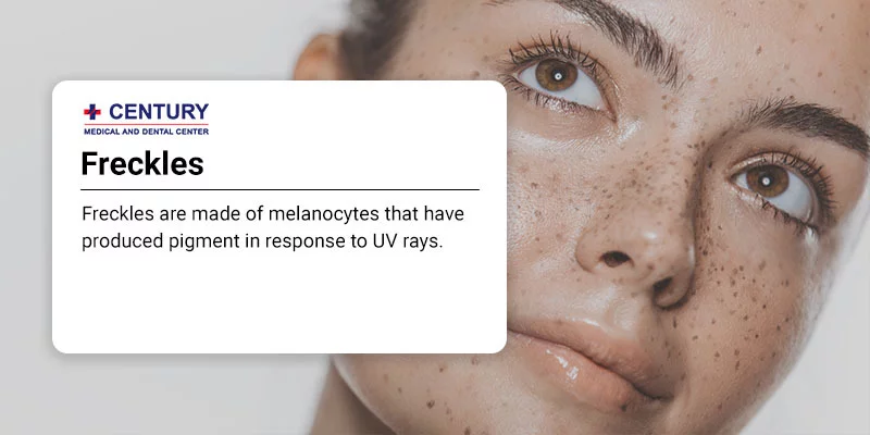 Freckles: What They Are, vs. Moles, Causes & Removal