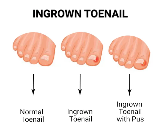 What Causes an Ingrown Toenail to Develop?