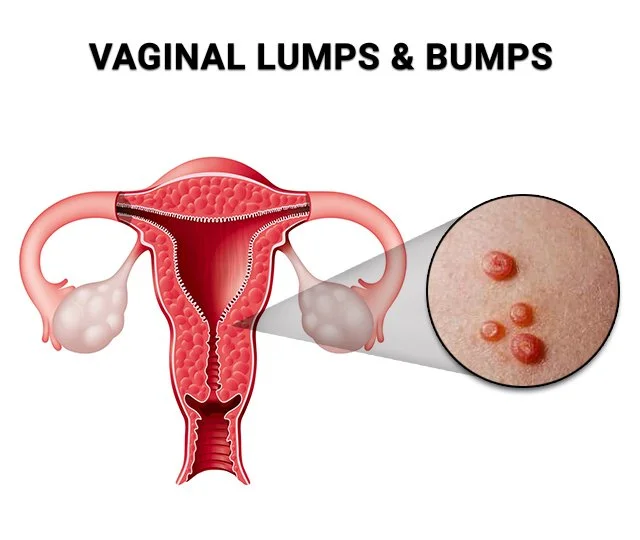 Bump on your vagina?