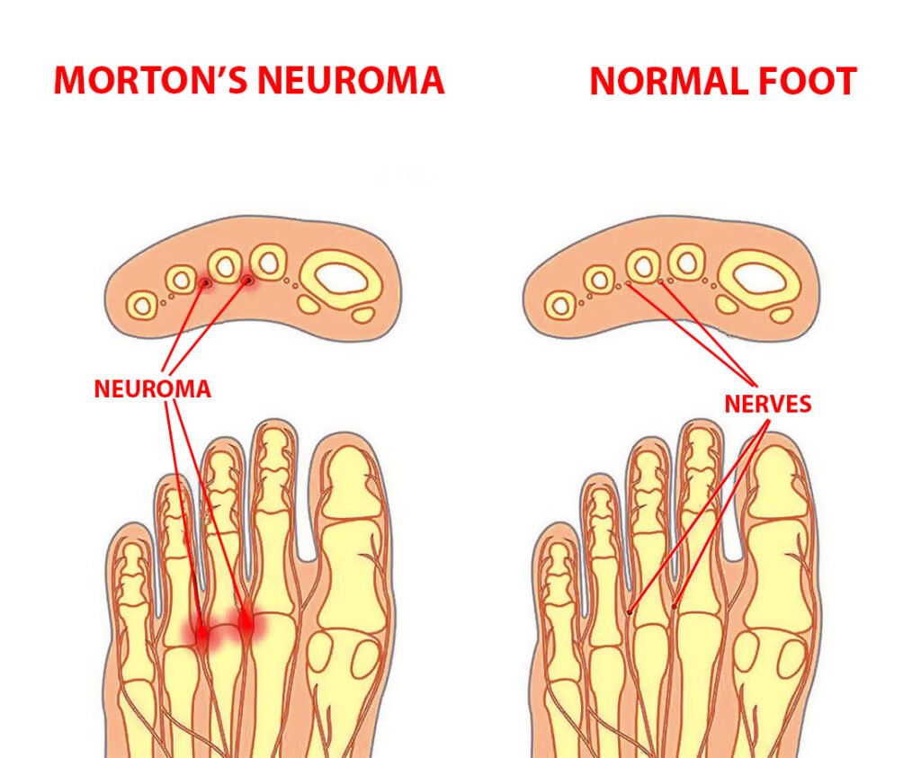 Mortons Neuroma Symptoms And Treatment Century Medical Dental Center