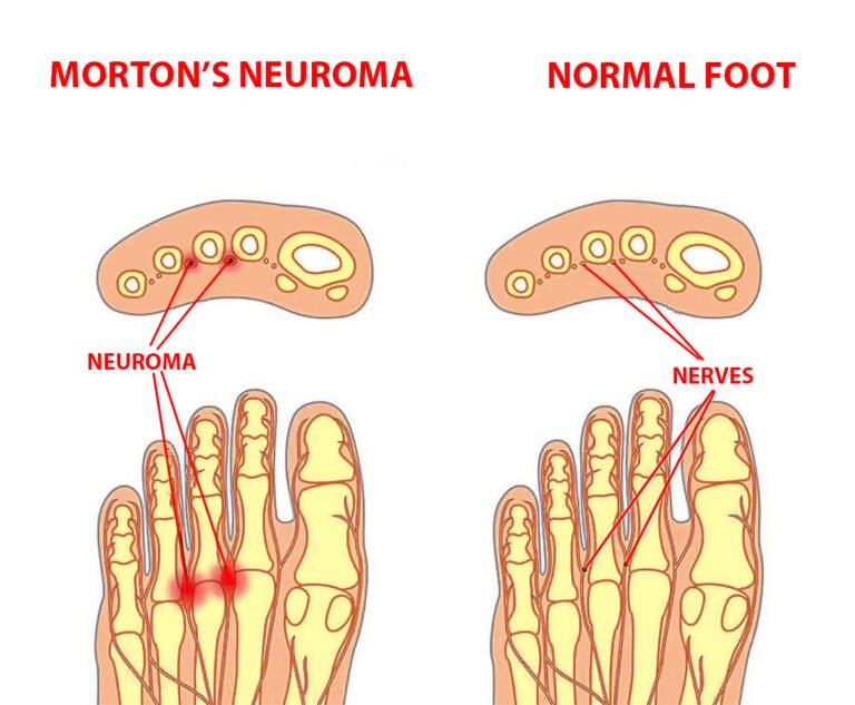 Morton’s Neuroma Symptoms and Treatment - Century Medical & Dental Center