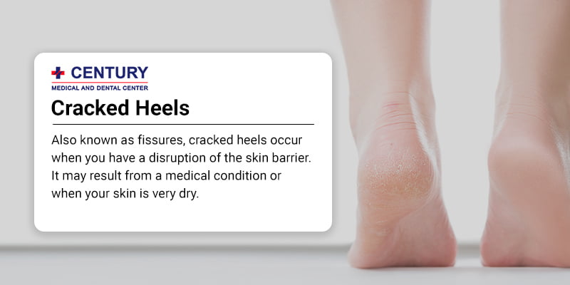 Close up cracked heel further deep cracks and dry flaky skin 15084087 Stock  Photo at Vecteezy