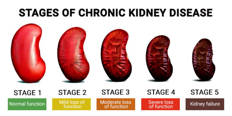 What Is Stage 5 CKD? - Century Medical & Dental Center