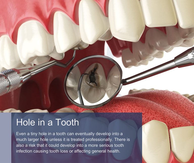 hole-in-tooth-treatment-in-manhattan-brooklyn-ny