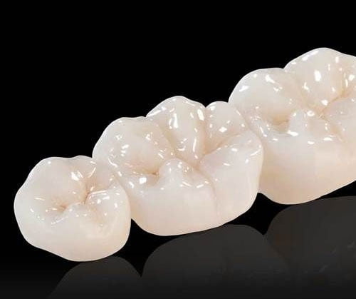 Dental Bridge in Manhattan & Brooklyn, NY | Implant Bridge